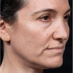 Thermage Before & After Patient #1588